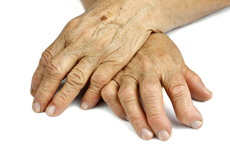Các khớp ngón tay của bệnh nhân bị biến dạng do bệnh viêm khớp ngón tay