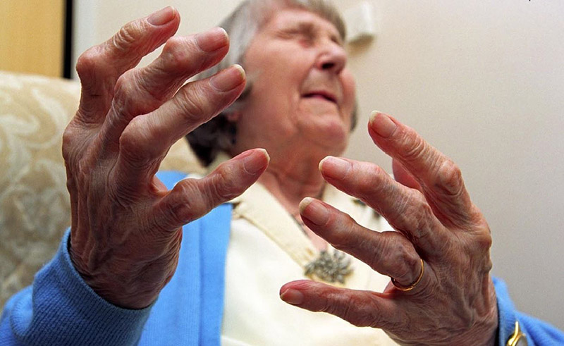 Hình ảnh bàn tay dị thường của bệnh nhân mắc viêm khớp dạng thấp