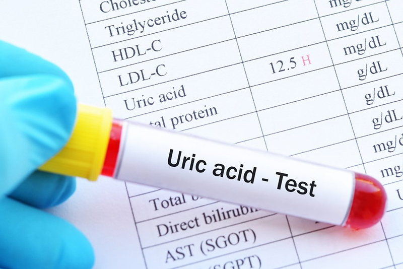 Xác định bệnh gout thông qua chỉ số acid uric