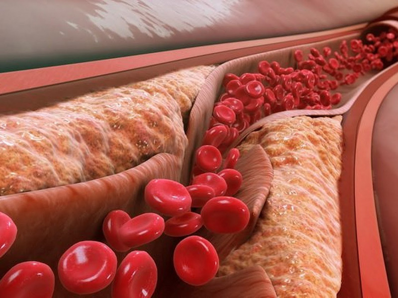 Xơ vữa động mạch ảnh hưởng trực tiếp đến sức khỏe con người